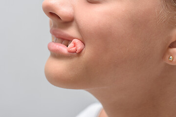 Image showing A bloody swab sticks out of the mouth of a ten-year-old girl after tooth extraction, close-up