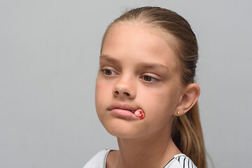 Image showing A bloody swab sticks out of the mouth of a ten-year-old girl after tooth extraction