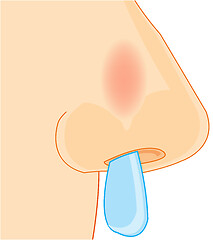 Image showing Vector illustration of the nose of the person sick with a cold