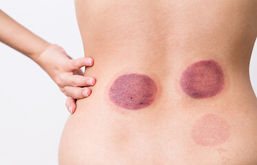 Image showing Woman blood marks massaged with cupping therapy