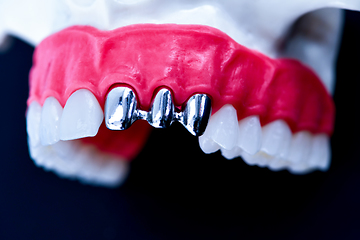 Image showing Tooth implant and crown installation process