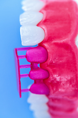 Image showing Tooth implant and crown installation process