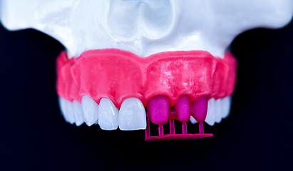 Image showing Tooth implant and crown installation process