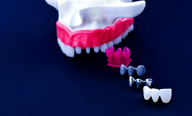 Image showing Tooth implant and crown installation process