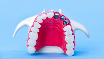 Image showing Tooth implant and crown installation process