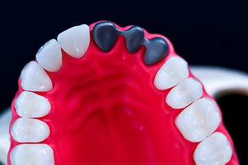 Image showing Tooth implant and crown installation process