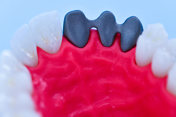 Image showing Tooth implant and crown installation process