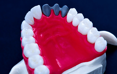 Image showing Tooth implant and crown installation process