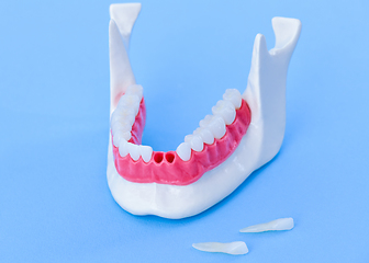 Image showing Tooth implant and crown installation process