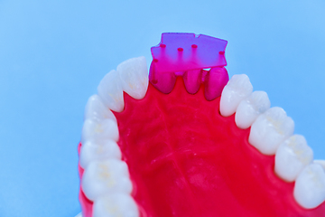 Image showing Tooth implant and crown installation process