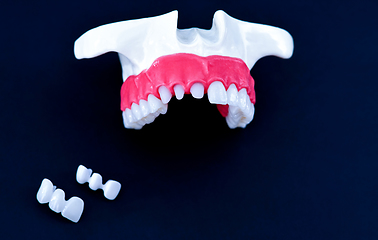 Image showing Tooth implant and crown installation process