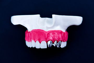 Image showing Tooth implant and crown installation process