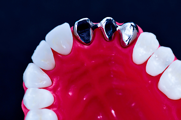 Image showing Tooth implant and crown installation process