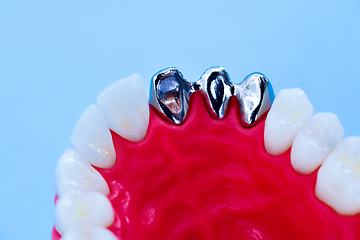 Image showing Tooth implant and crown installation process