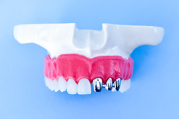 Image showing Tooth implant and crown installation process