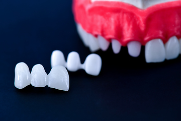 Image showing Tooth implant and crown installation process