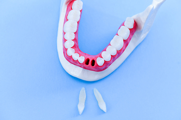 Image showing Tooth implant and crown installation process