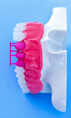 Image showing Tooth implant and crown installation process