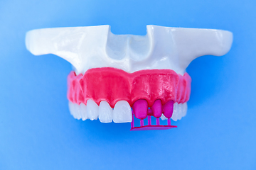 Image showing Tooth implant and crown installation process