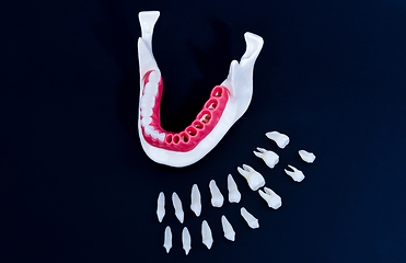 Image showing Tooth implant and crown installation process