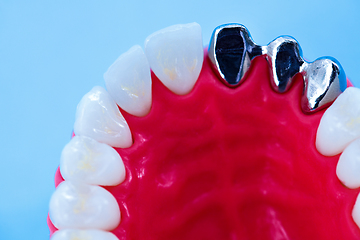 Image showing Tooth implant and crown installation process