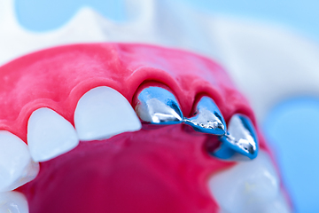 Image showing Tooth implant and crown installation process