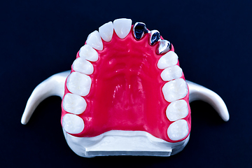 Image showing Tooth implant and crown installation process