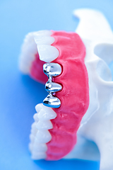 Image showing Tooth implant and crown installation process