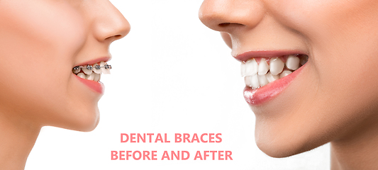 Image showing Close up female portrait, dental braces before and after