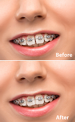 Image showing Close up female portrait, dental braces before and after