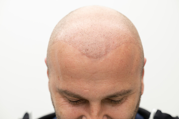 Image showing man after hair implant therapy