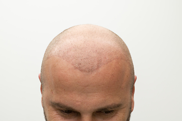 Image showing man after hair implant therapy