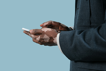 Image showing Close up of male hands with vitiligo pigments isolated on blue studio background