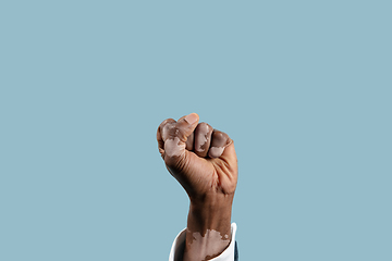 Image showing Close up of male hands with vitiligo pigments isolated on blue studio background