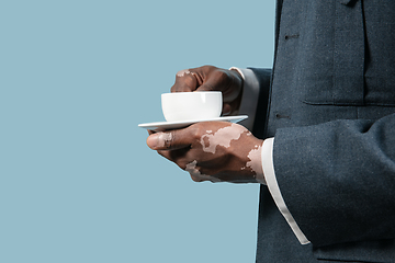 Image showing Close up of male hands with vitiligo pigments isolated on blue studio background