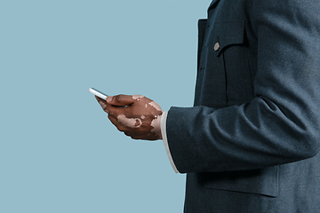 Image showing Close up of male hands with vitiligo pigments isolated on blue studio background