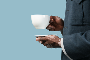 Image showing Close up of male hands with vitiligo pigments isolated on blue studio background