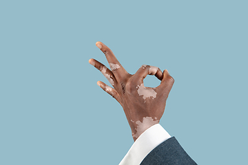 Image showing Close up of male hands with vitiligo pigments isolated on blue studio background