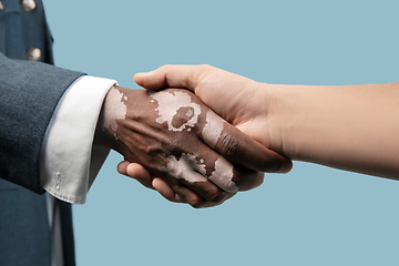 Image showing Close up of male hands with vitiligo pigments isolated on blue studio background