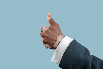 Image showing Close up of male hands with vitiligo pigments isolated on blue studio background