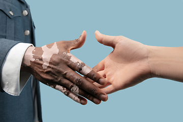 Image showing Close up of male hands with vitiligo pigments isolated on blue studio background