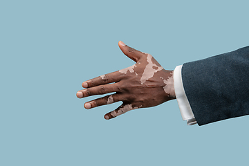 Image showing Close up of male hands with vitiligo pigments isolated on blue studio background