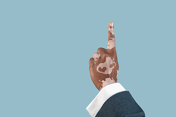 Image showing Close up of male hands with vitiligo pigments isolated on blue studio background