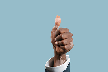 Image showing Close up of male hands with vitiligo pigments isolated on blue studio background