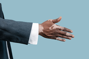 Image showing Close up of male hands with vitiligo pigments isolated on blue studio background