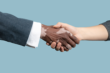 Image showing Close up of male hands with vitiligo pigments isolated on blue studio background