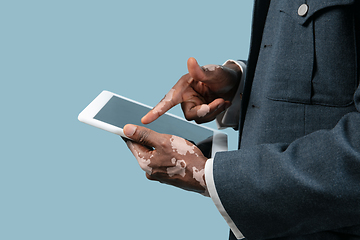 Image showing Close up of male hands with vitiligo pigments isolated on blue studio background