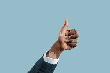 Image showing Close up of male hands with vitiligo pigments isolated on blue studio background