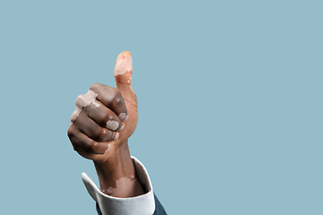 Image showing Close up of male hands with vitiligo pigments isolated on blue studio background