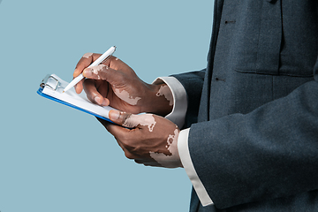 Image showing Close up of male hands with vitiligo pigments isolated on blue studio background